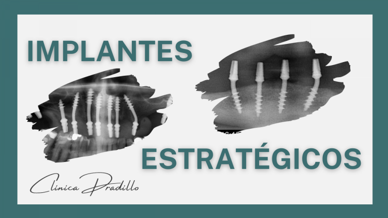 Implantes estratégicos o implantes basales en Clínica Pradillo clínica dental de confianza en Madrid