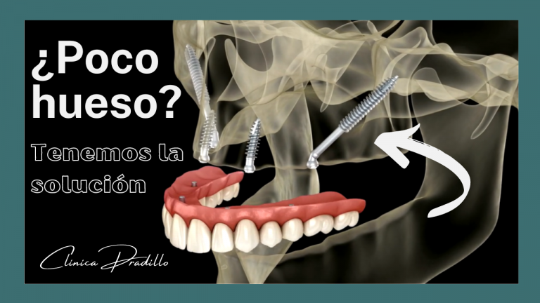 Implantes zigomáticos en Clínica Pradillo clínica dental de confianza en Madrid