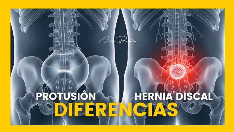 Ilustración médica mostrando las diferencias entre una protrusión discal y una hernia discal lumbar