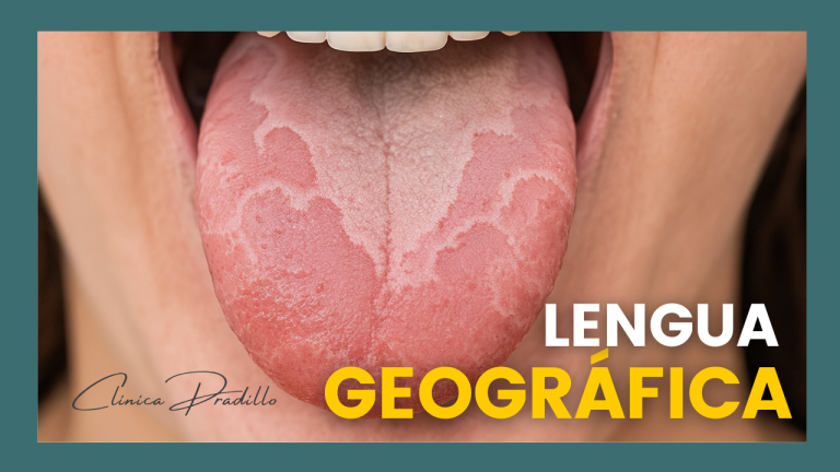 qué es la lengua geográfica y cuáles son sus síntomas característicos, diagnosticada en Clínica Pradillo en Chamartín