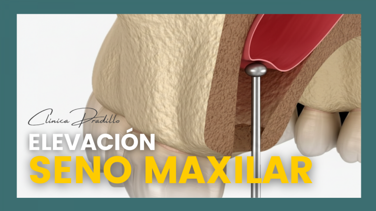 Elevació de seno maxilar en clínica pradillo previo a implante dental