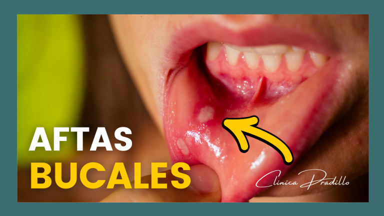 Primer plano de una afta bucal en el interior de la boca, ilustrando el tratamiento para aftas en Clínica Pradillo Madrid