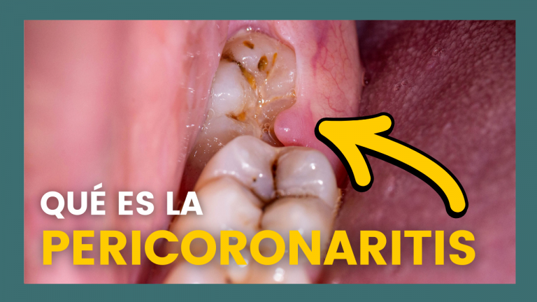 qué es la pericoronaritis y cómo tratarla en Clínica Pradillo