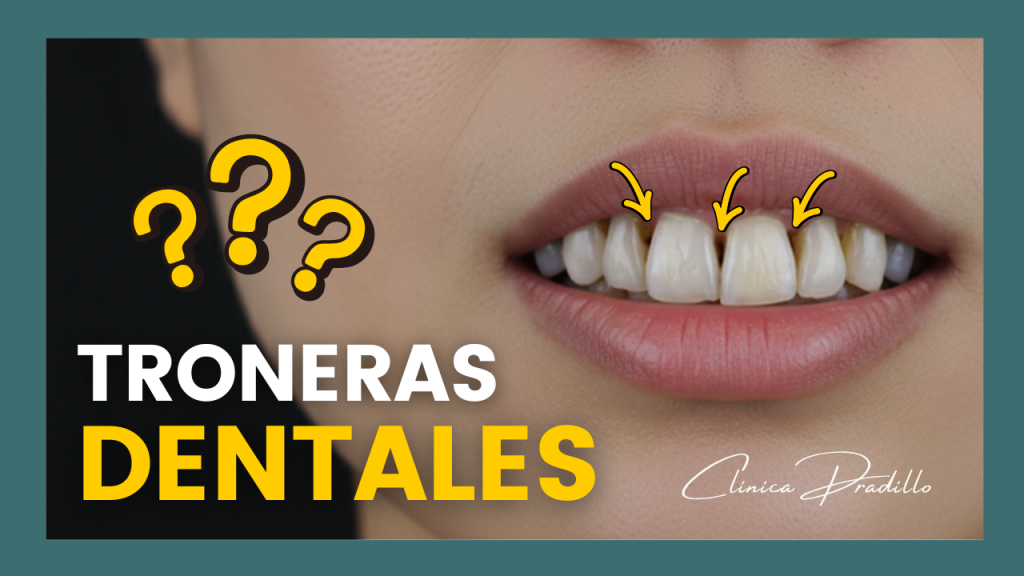 Qué son las troneras dentales