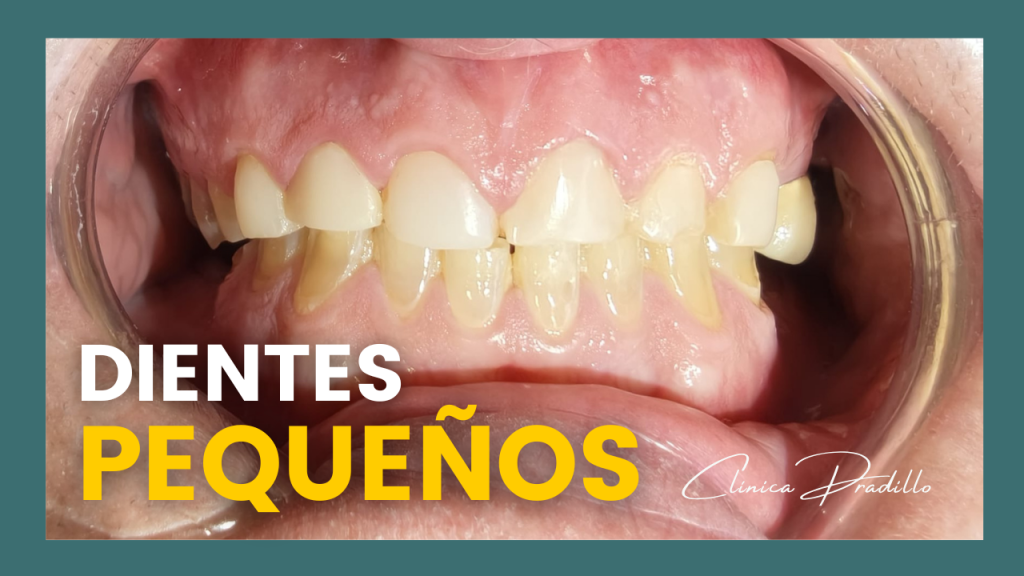 Primer plano de dientes más cortos y desgastados por desgaste dental, una preocupación estética y funcional tratada en Clínica Pradillo