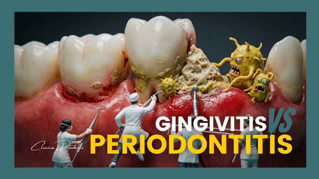 Diferencia entre gingivitis y periodontitis: encías inflamadas vs retracción de encías