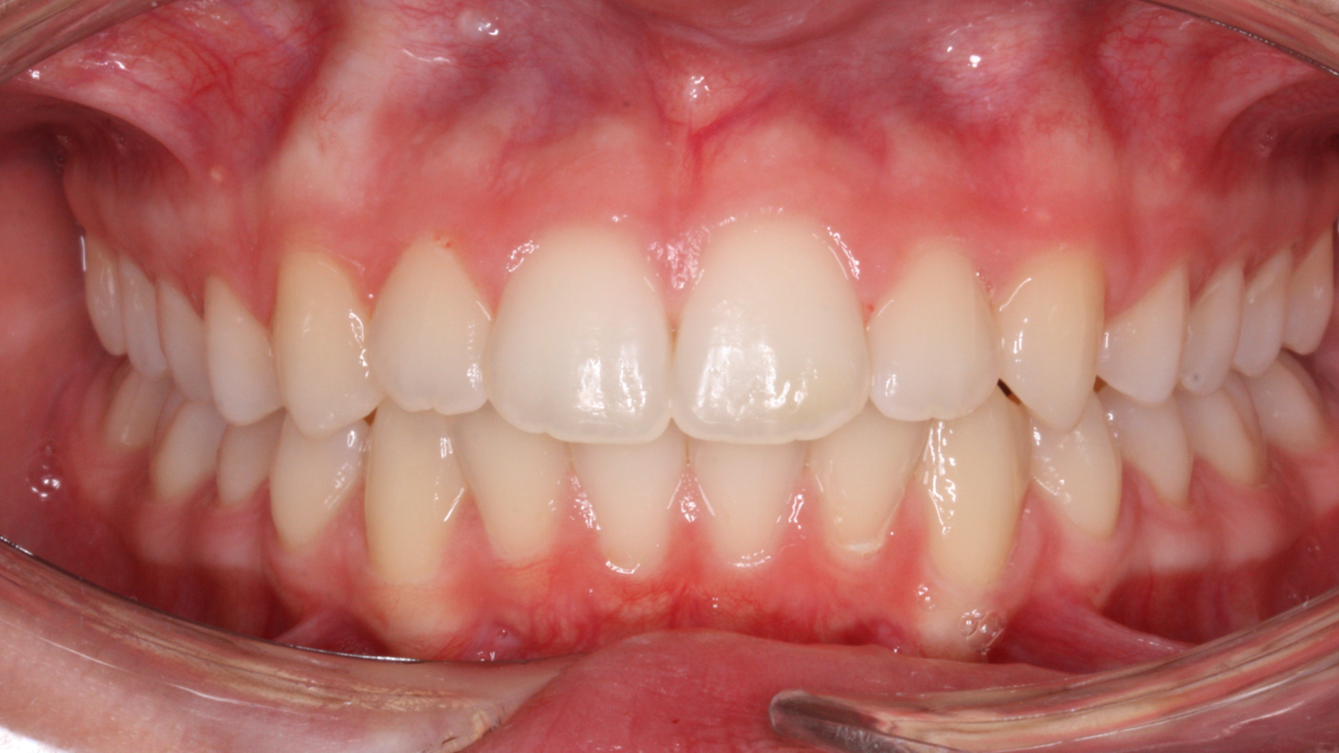 Después - Falta de Espacio