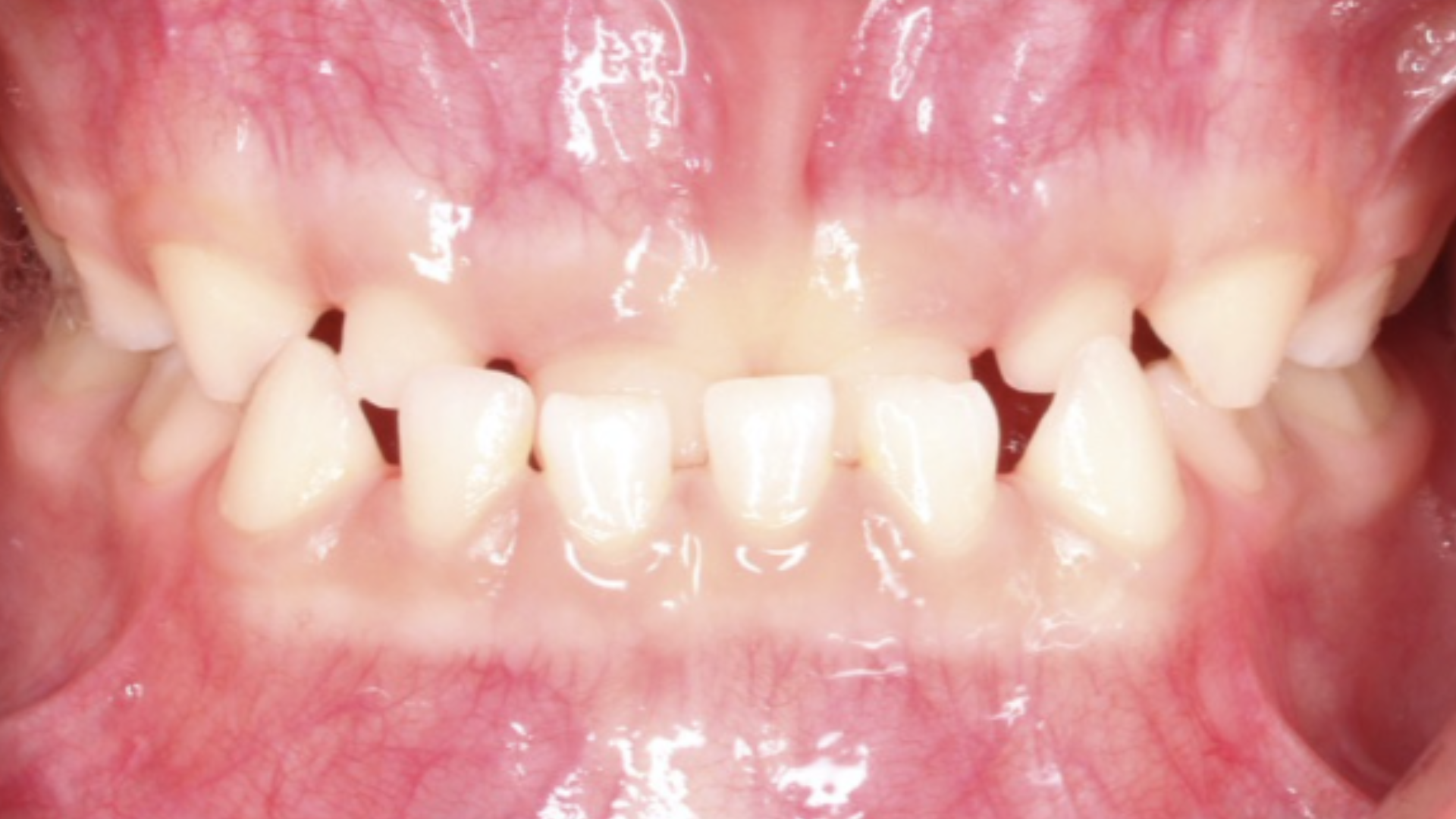 Antes - Mordida invertida