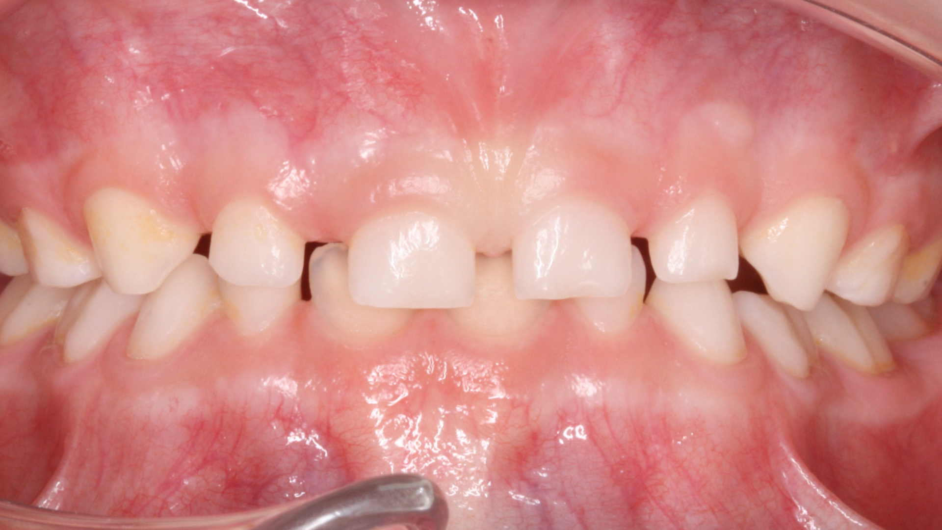 Después - Mordida invertida