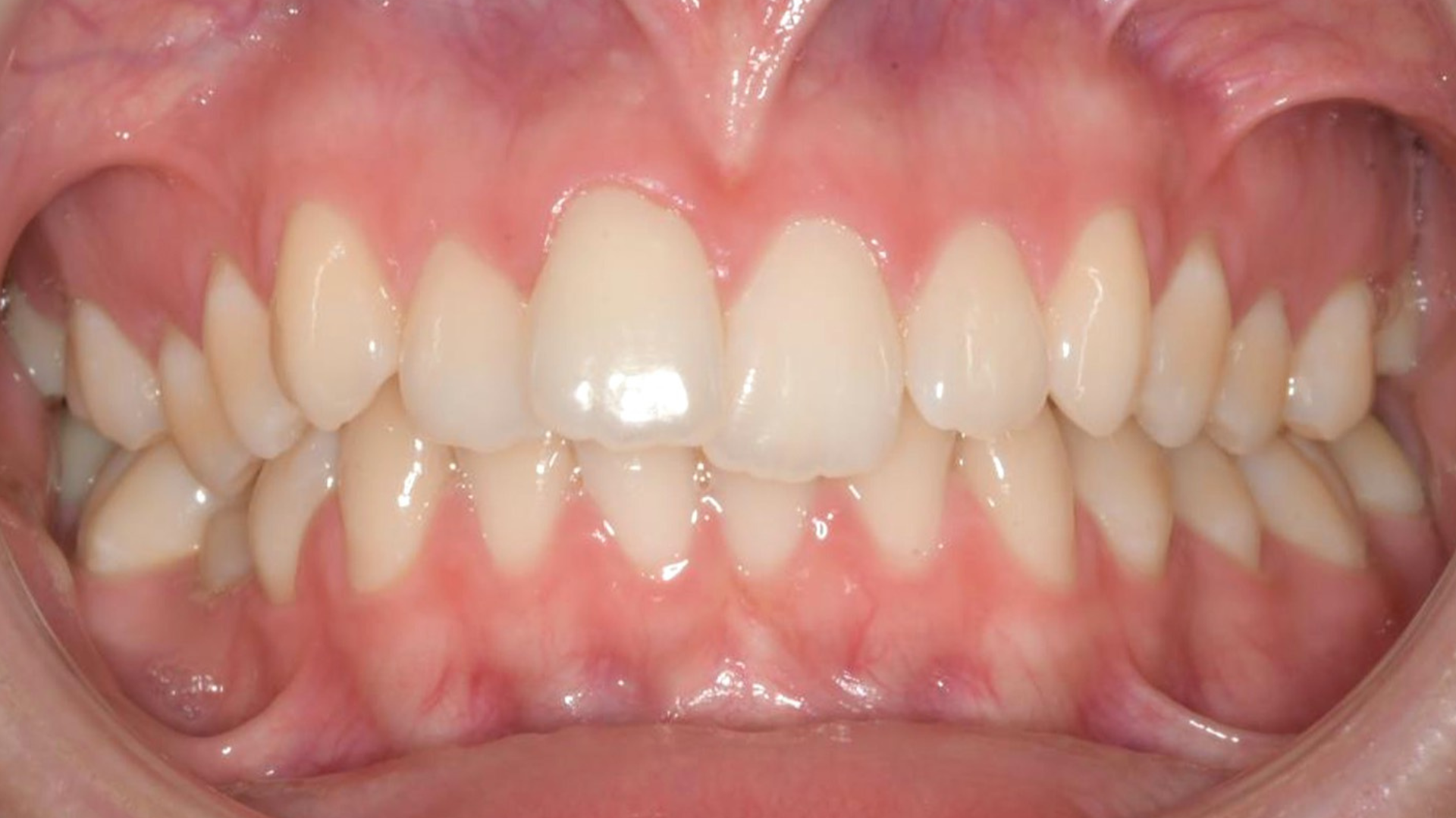 Antes - Apiñamiento ligero