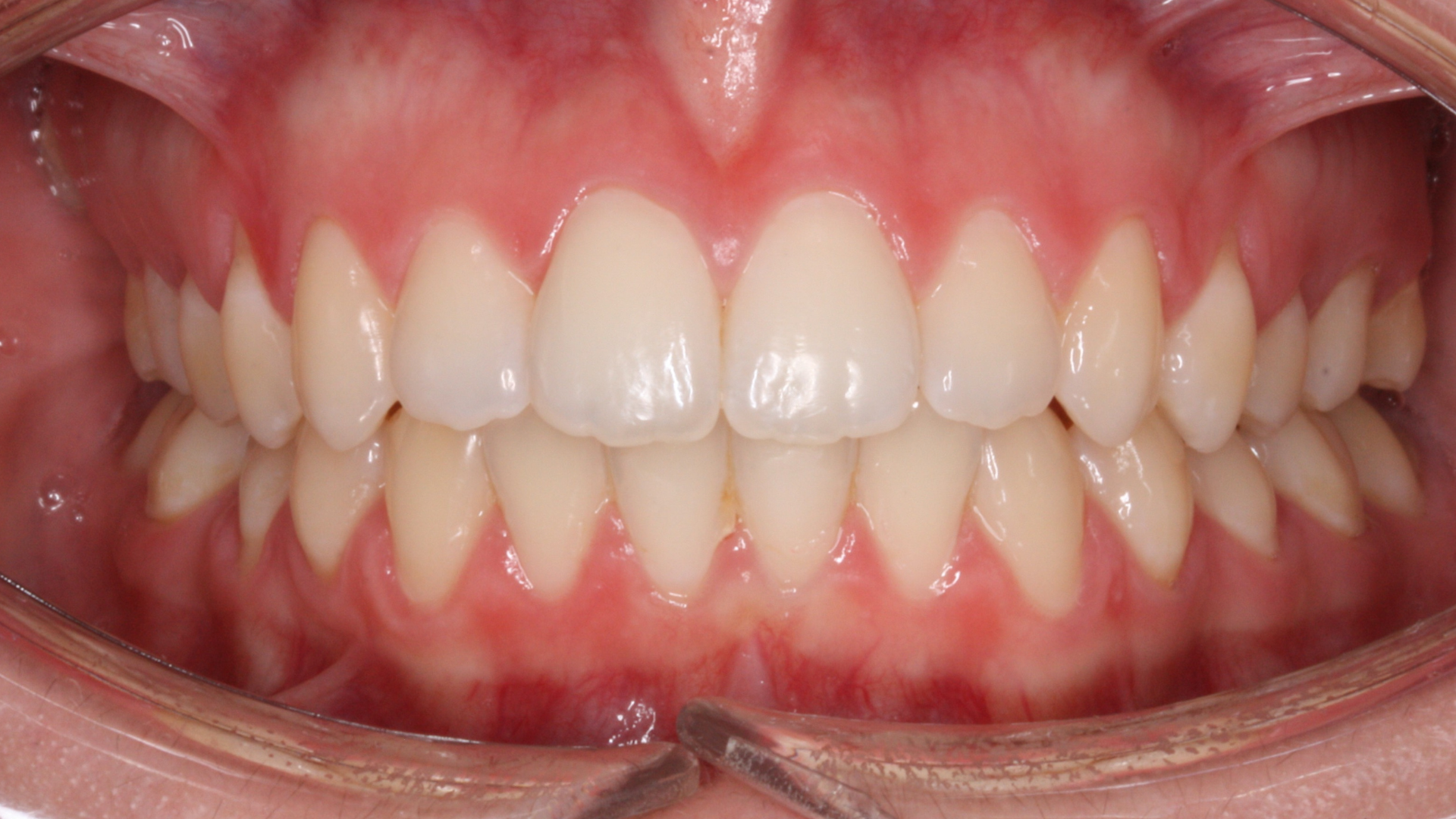 Después - Apiñamiento ligero