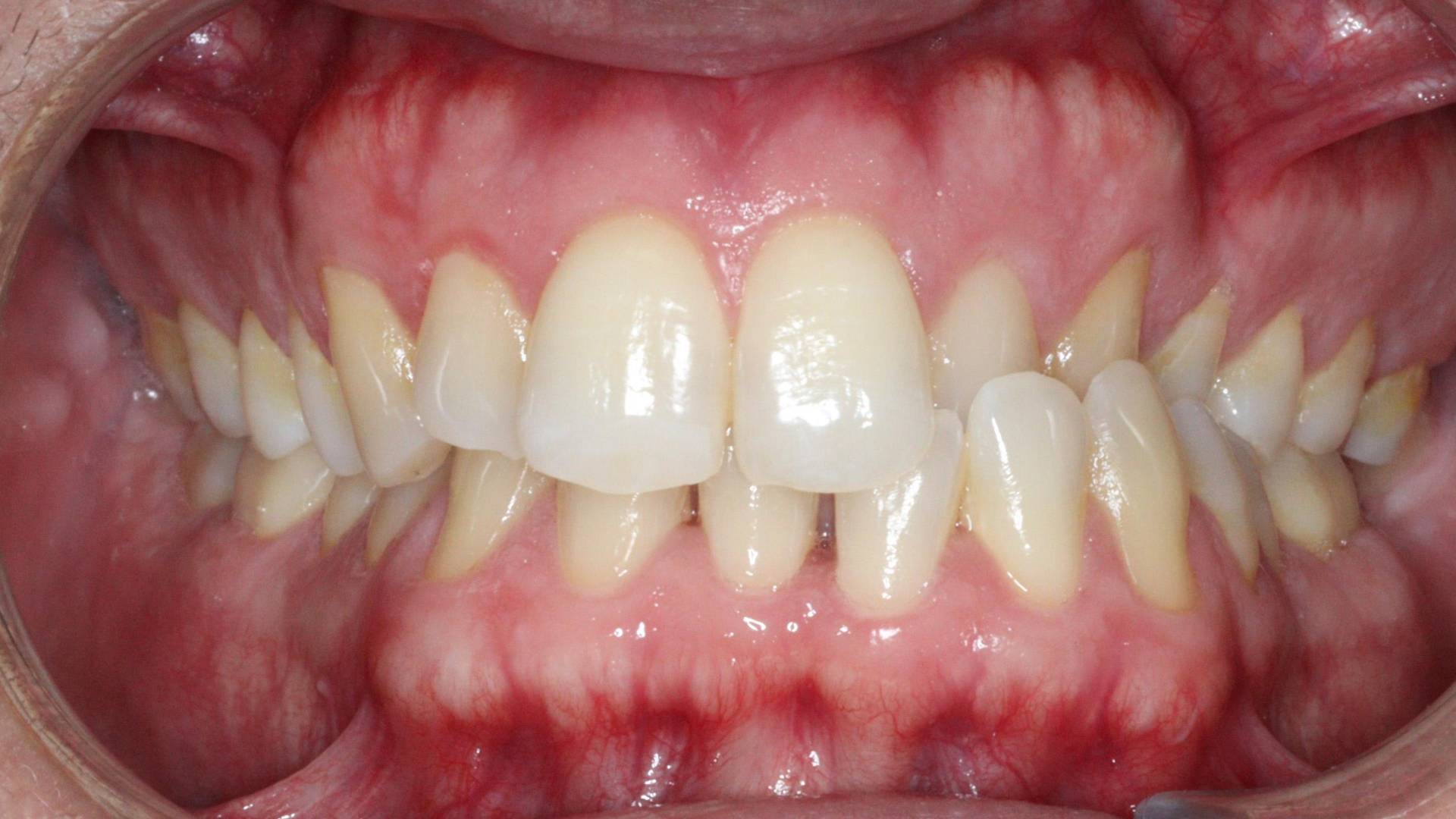 Antes - Compresión bimaxilar