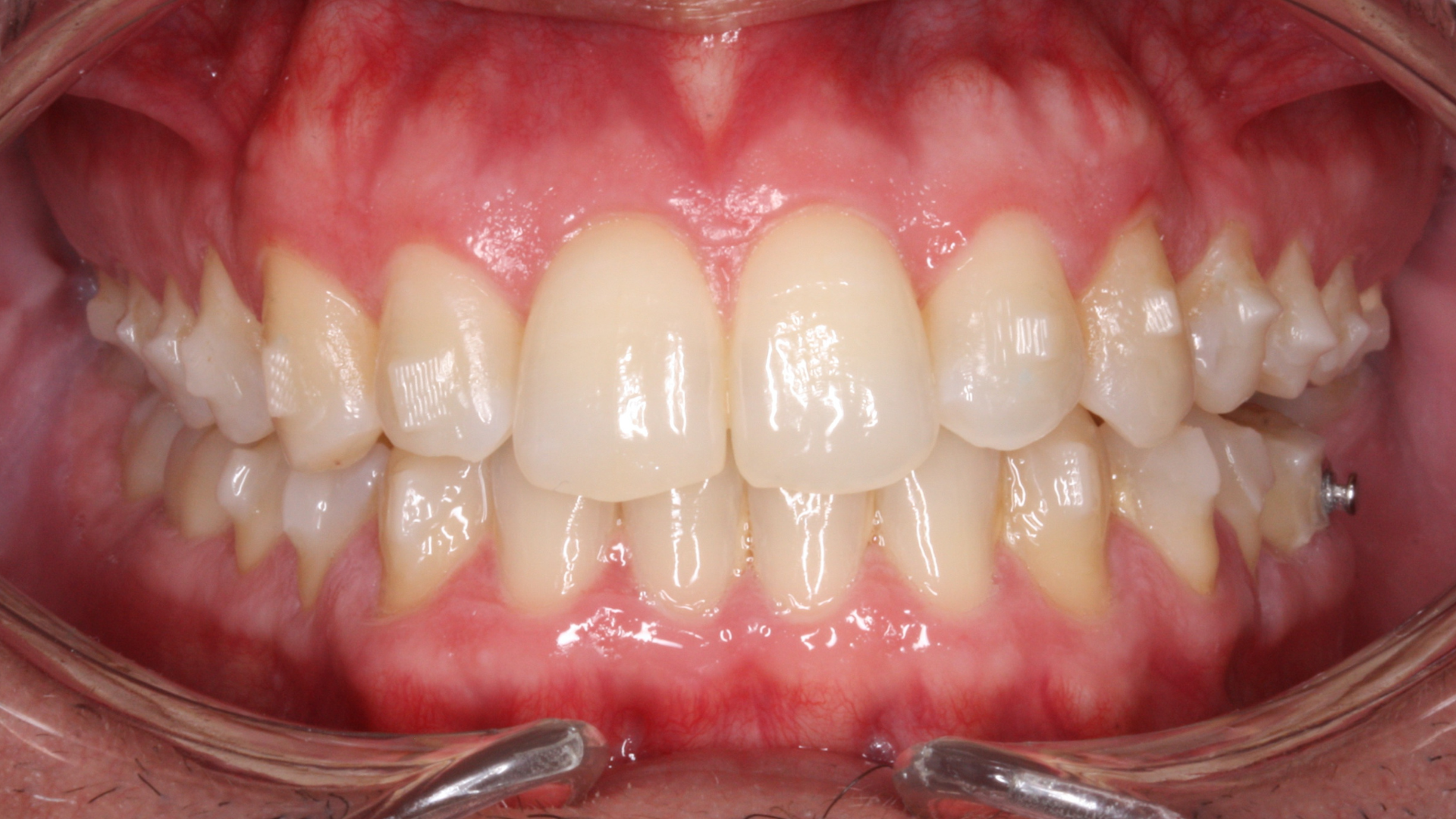 Durante - Compresión bimaxilar