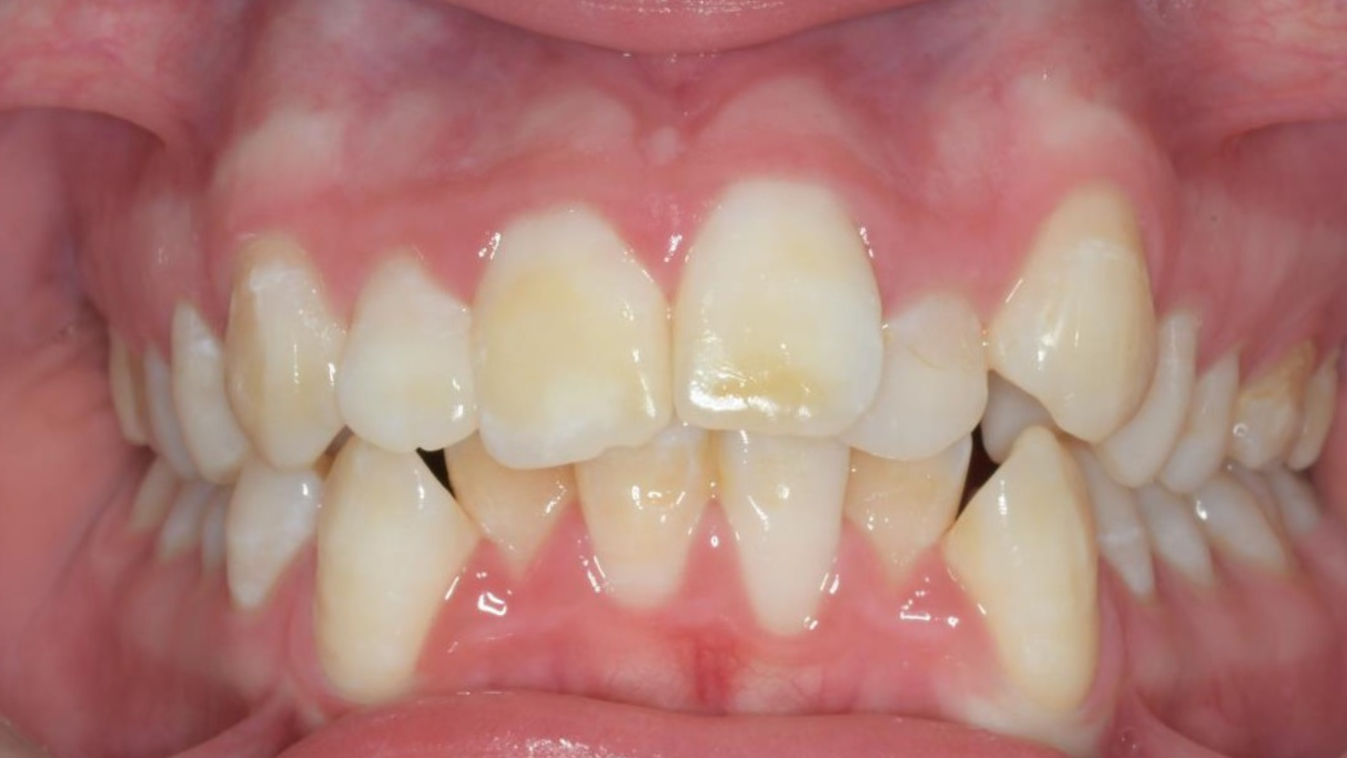 Antes - Gran apiñamiento