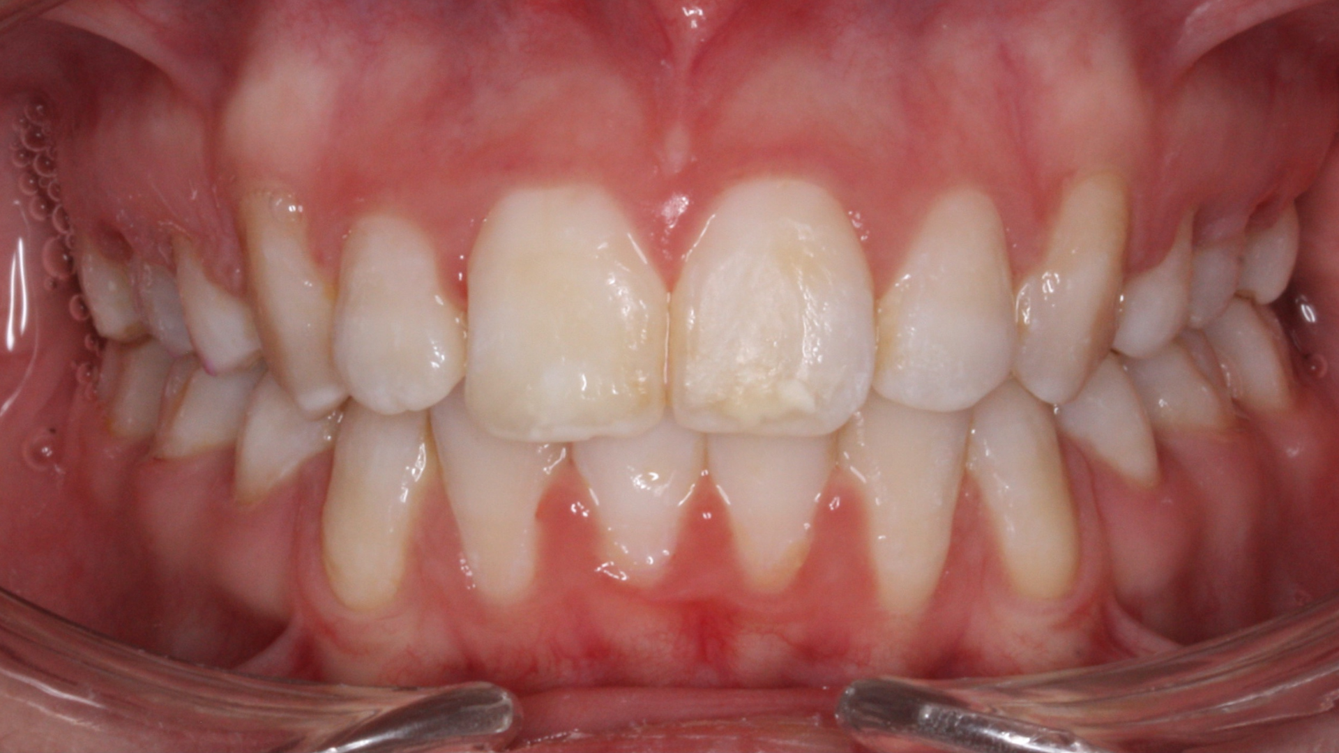 Después - Gran apiñamiento