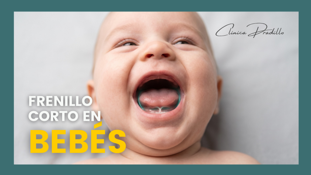 cómo saber cuándo hay un frenillo corto en bebés