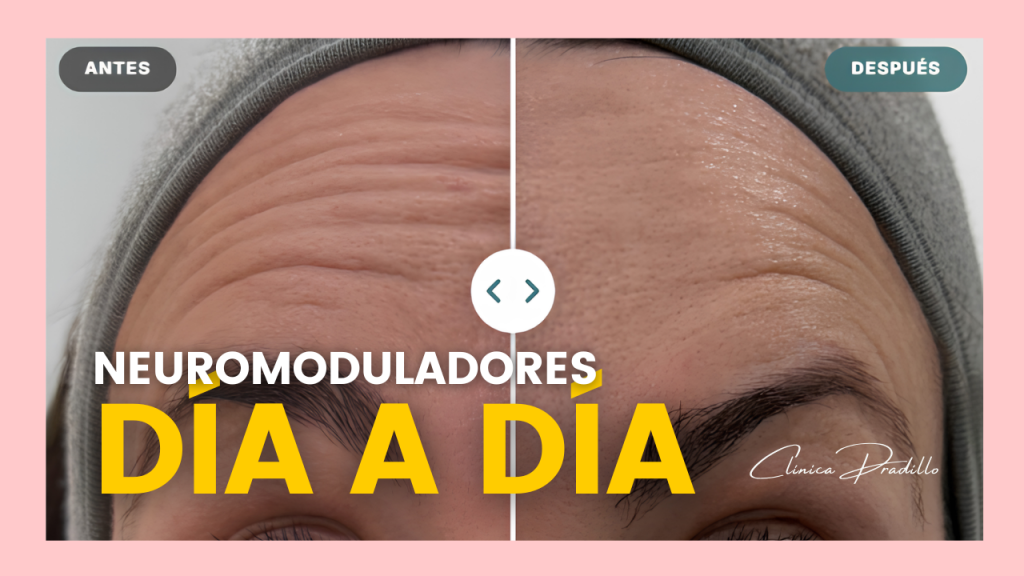 neuromoduladores día a día en Clínica Pradillo en Chamartín